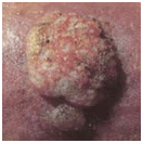 skin6