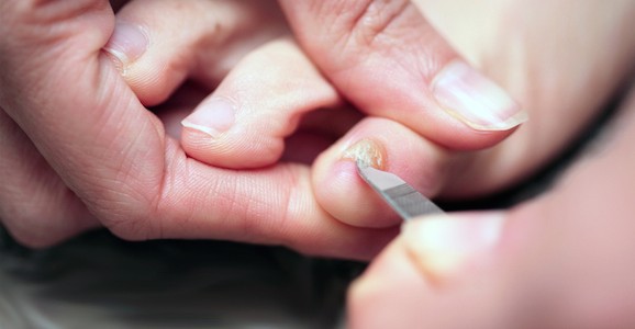 Fungal Nail Infections · Elio's Foot Comfort Centre