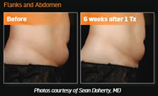 gcmp-body-contouring-sculpsure-before-after-1