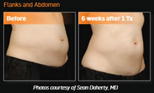 gcmp-body-contouring-sculpsure-before-after-1