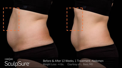 gcmp-body-contouring-sculpsure-before-after-a2
